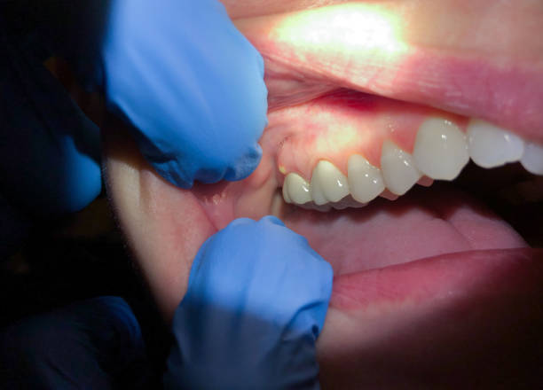 Best Urgent Tooth Repair  in Gibbsboro, NJ